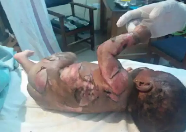 Photos: Baby suffers severe burns after kerosene explosion